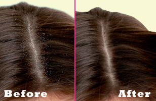 Rs. 75 for a complete screening of scalp and hair root worth Rs. 500